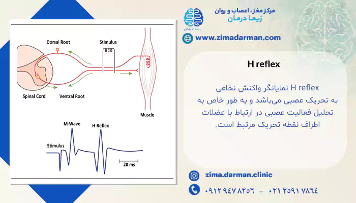 H reflex در نوار عصب و عضله
