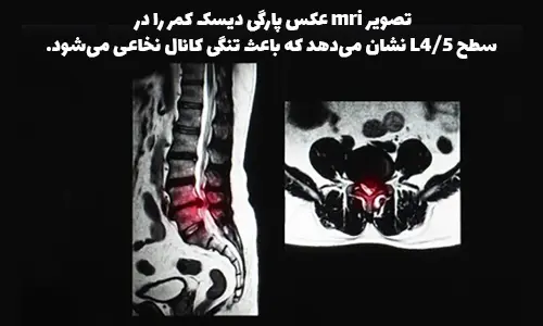 mri عکس پارگی دیسک کمر را در سطح L4/5 نشان میدهد که باعث تنگی کانال نخاعی میشود.