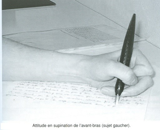 نهم: چرخش بیش از حد ساعد به بیرون (Supination Excess)