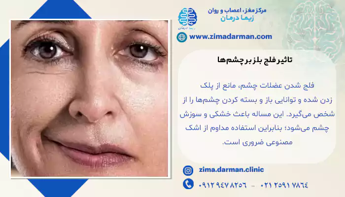 تاثیر فلج بلز بر چشم‌ها