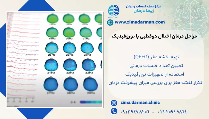 تصویر نقشه مغزی که یکی از مراحل درمان اختلال دوقطبی با نوروفیدبک است.