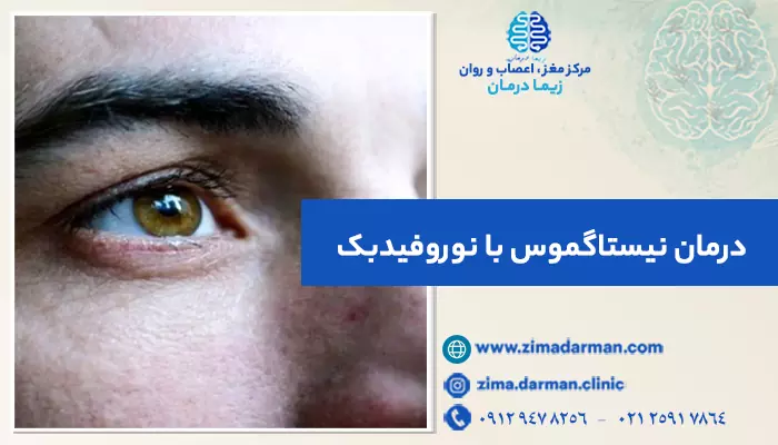 درمان نیستاگموس با نوروفیدبک | درمان قطعی نیستاگموس