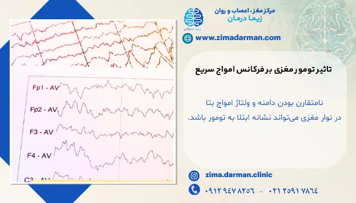 تصویر تومور مغزی در نوار مغز