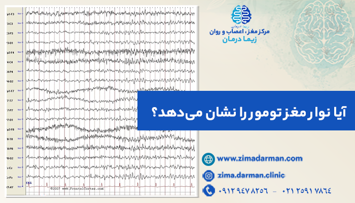 تصویر نوار مغز تومور، آیا نوار مغز تومور را نشان می دهد؟ آیا تومور مغزی در نوار مغز مشخص می شود؟