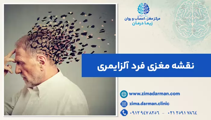 نقشه مغزی فرد آلزایمری