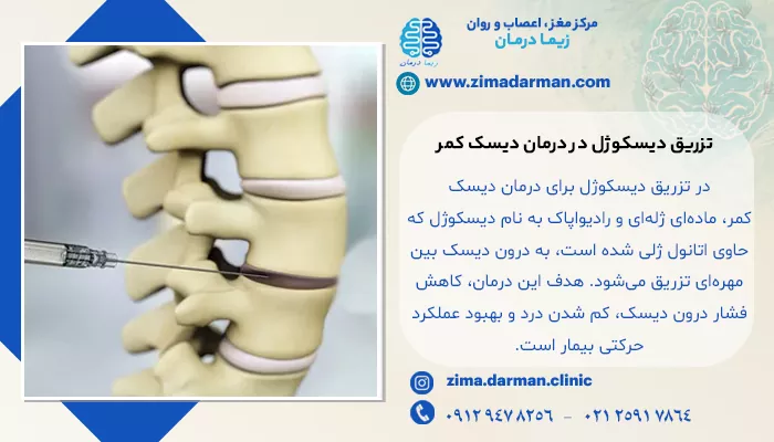 تزریق دیسکوژل در درمان دیسک کمر