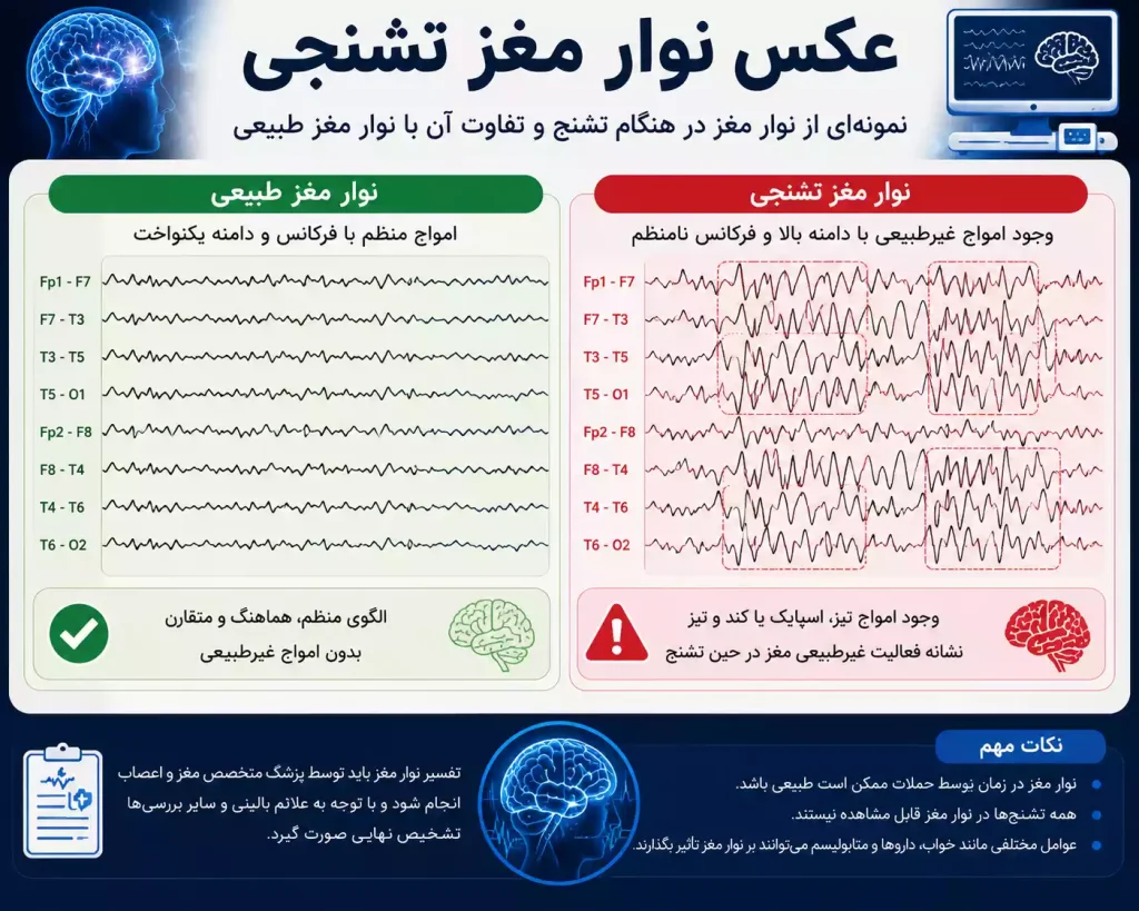 اینفوگرافی عکس نوار مغز تشنجی چگونه است؟ امواج تشنج در نوار مغز