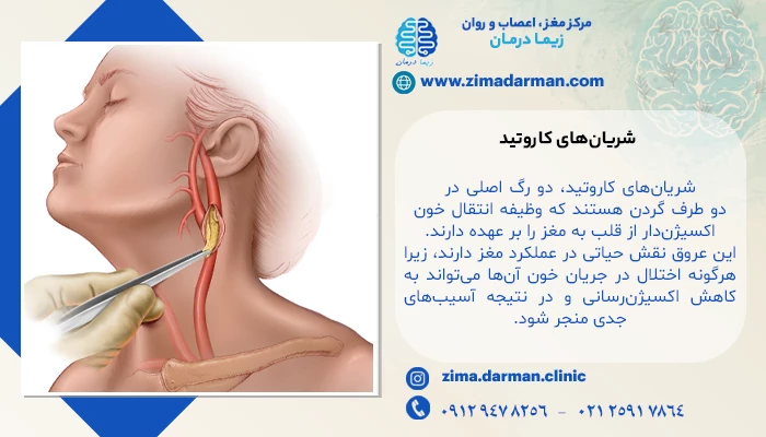 شریانهای کاروتید: مسیر حیاتی خون به مغز و ارتباط آن با سکته
