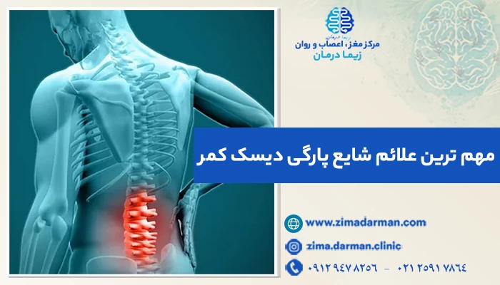مهم ترین علائم شایع پارگی دیسک کمر؛ آیا تشخیص بدون MRI امکانپذیر است؟
