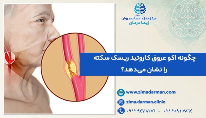 چگونه اکو عروق کاروتید ریسک سکته را نشان می‌دهد؟ سکته در اکو عروق کاروتید