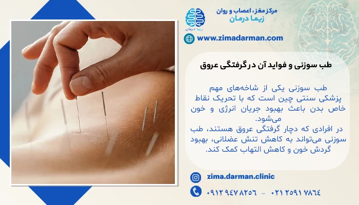 طب سوزنی و فواید آن در گرفتگی عروق